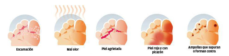 Síntomas del pie de atleta